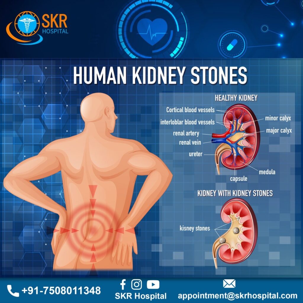 Human kidney stone solution