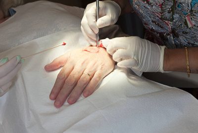 Making a surgical incision. Doctor uses a scalpel and makes a cut around a melanoma on the back of a hand. Mohs Surgery Technique. Overhead light illuminates the area. Patient lies with her hand on her abdomen and the doctor begins surgery. Nurse holds a swab close by. It has a little blood already on it. Patient is wearing a wedding ring. Doctor wears a bracelet. Clear focus on incision.